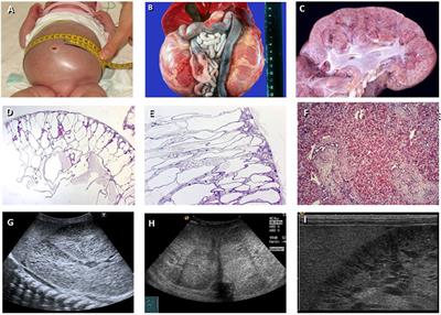 Genetics of Autosomal Recessive Polycystic Kidney Disease and Its Differential Diagnoses